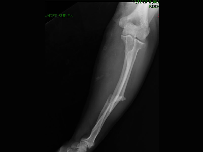 Fractura de radio y cúbito