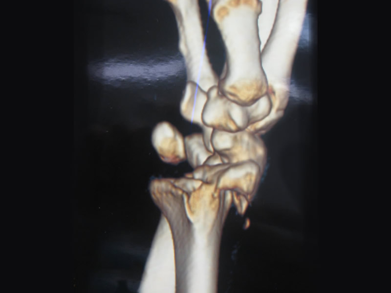 Fractura y luxación de muñeca