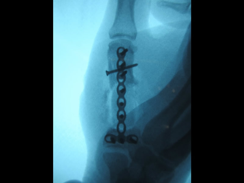 Reconstrucción del pulgar por lesión por proyectil de arma de fuego