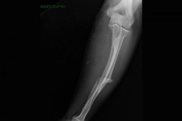 Fractura de radio y cúbito