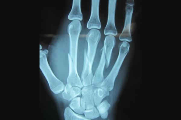 Fracturas de metacarpos
