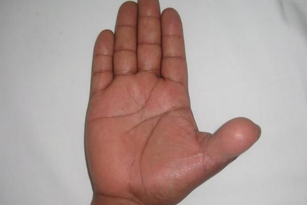 Reconstrucción de pulgar con transferencia de pié a mano