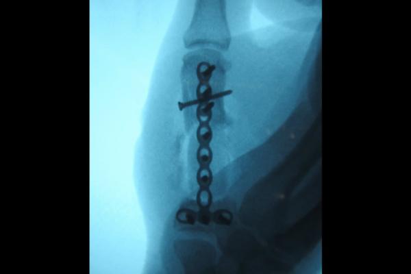 Reconstrucción del pulgar por lesión por proyectil de arma de fuego
